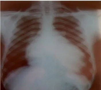 Figure 4 : Radiographie du thorax, incidence de face montrant 