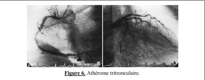 Figure 6. Athérome tritronculaire. 