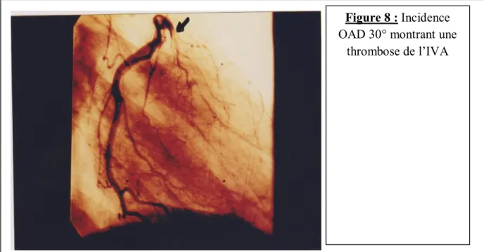 Figure 8 : Incidence  OAD 30° montrant une 