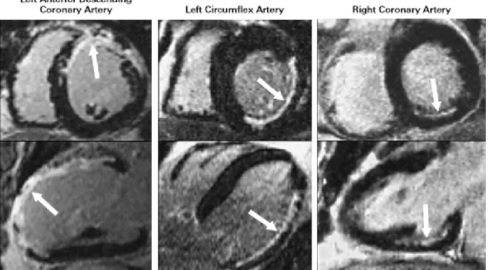 Figure 11 : Rehaussement tardif à en petit axe et grand axe   chez trois patients différents