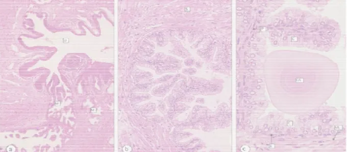 Figure 7: histologie de la prostate montrant les corps de Robin