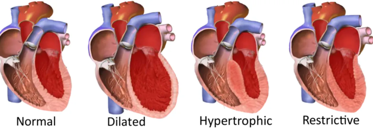 Figure 1.9 – Épaisseur du myocarde en fonction de la forme de cardiomyopathie. D’après [Blausen- [Blausen-staff, 2014].