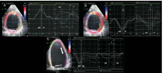 Figure 2.9 – Strain radial, circonférentiel et longitudinal en échocardiographie 2D chez un patient sain (courbes de gauche) et chez un patient souffrant d’asynchronisme cardiaque (courbes de droite).