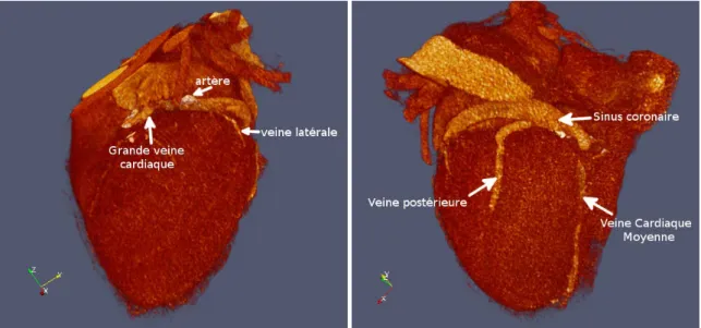 Figure 3.3 – Rendu volumique des veines coronaires chez le patient 15 à 40% du cc. Gauche : vue antéro-latérale ; Droite : vue latérale.