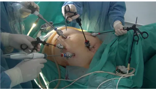 Figure 4: la disposition des trocarts lors d’une résection sous cœlioscopie  (Chirurgie C)  