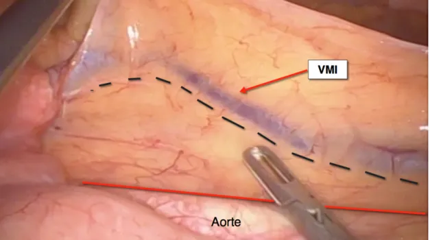 Figure 5  Image per-operatoire montrant la VMI et l’aorte (Chirurgie C)  