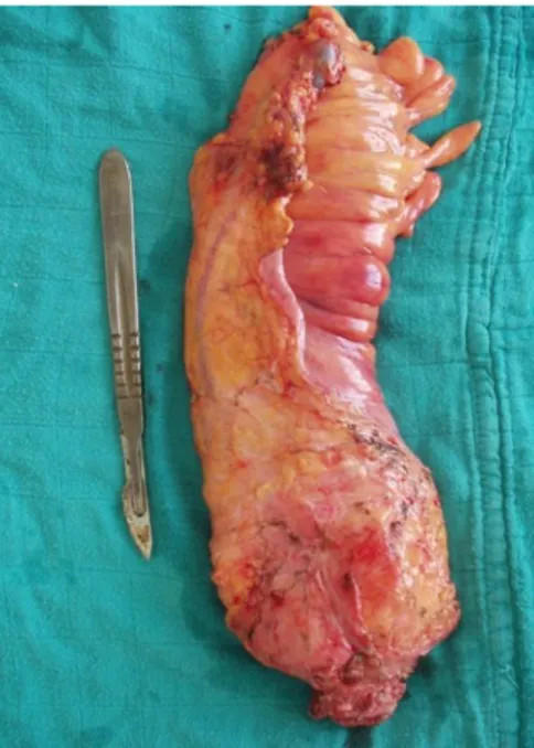 Figure 7 : photographies de pièces opératoires d’exérèse   totale du mésorectum (Chirurgie C ) 