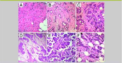 Figure 7 : Images histologiques de différents carcinomes invasifs du sein A-carcinome  lobulaire B-carcinome tubulaire C-carcinome cribriforme D-carcinome mucineux 