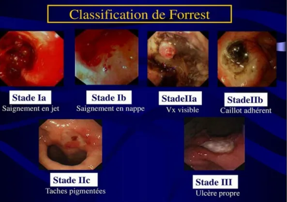 Figure 5 : Classification de Forrest [15] 