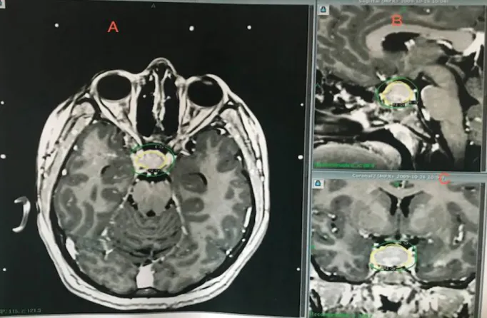 Figure 8:Images IRM d’un craniopharyngiome à triple composante en pré-opératoire. 