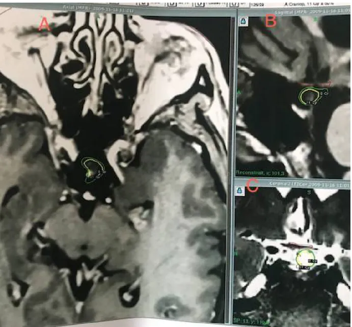 Figure 19: Images IRM d’un craniopharyngiome de type mixte en pré-opératoire. 