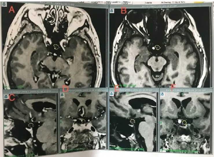 Figure 20:Images IRM d’un craniopharyngiome traité par radiochirurgie Gamma  Knife 