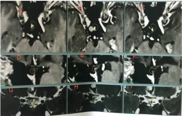 Figure 21: Images IRM d’un craniopharyngiome traité par radiochirurgie Gamma  Knife 