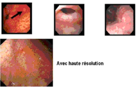 Figure 6 : Gastrite atrophique endoscopie (88) 