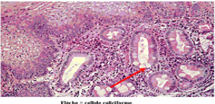 Figure 7 : Métaplasie intestinale (88) 