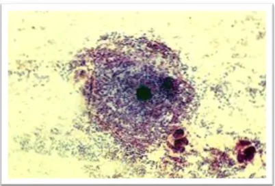 Figure  3 : Cellule épithéliale desquamant et entraînant avec elle les bactéries adhérentes :  Coloration de Gram ; Grossissement X 400[2]