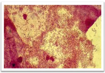 Figure  16 : « Comma-cell » à Mobiluncus : Coloration de Gram : Grossissement X 400[2] 