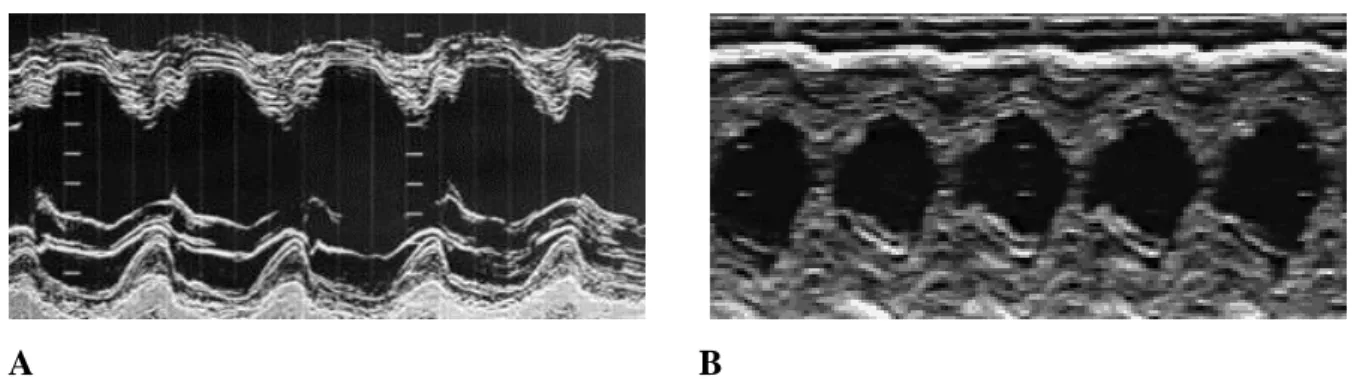 Figure  5  :  Illustration de l’effet  inotrope positif  de l’isoprotérénol  en échocardiographie  en  coupe  parasternale  grand  axe