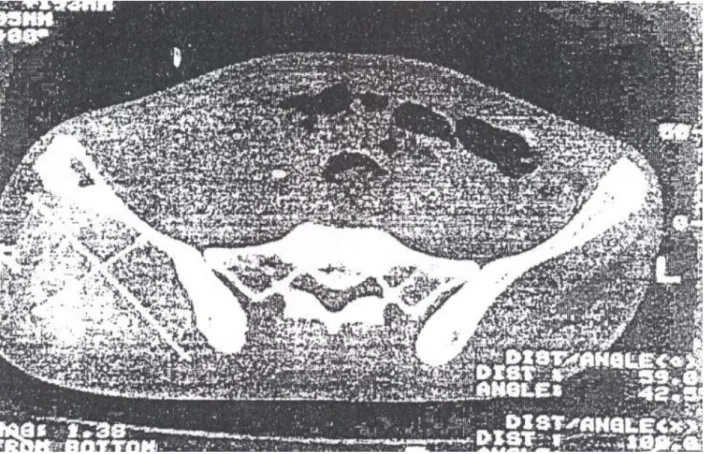Figure 3 : la tomodensitométrie du bassin visualise un processus expansif de la fesse droite