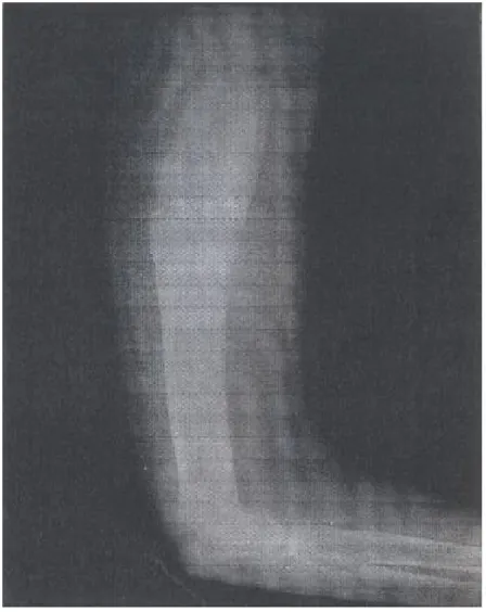 Figure 3 : La radiographie standard du bras montre un remaniement osseux   avec ostéolyse et un aspect feuilleté de la corticale