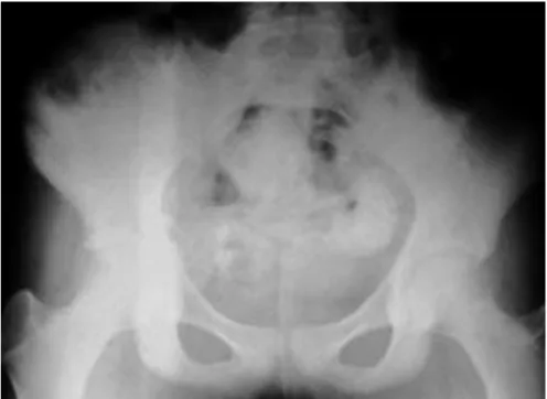 Figure 9: sarcome d’Ewing de l’aile iliaque droite image discrète en   radiographie conventionnelle
