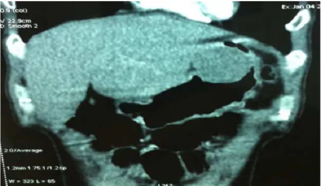 Figure 8: TDM abdominale en coupe frontale montrant une masse en saillie dans la  lumière gastrique