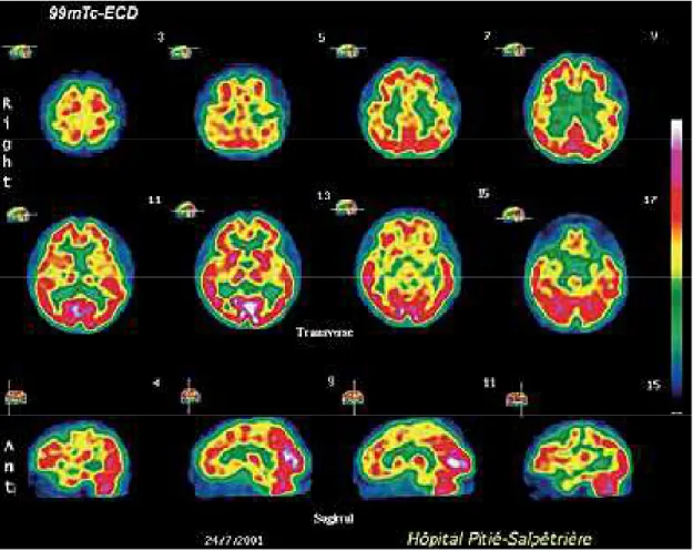 Figure 5-2 : Imagerie de perfusion en SPECT montre une diminution  importante de la perfusion au niveau des régions operculo-insulaires et 