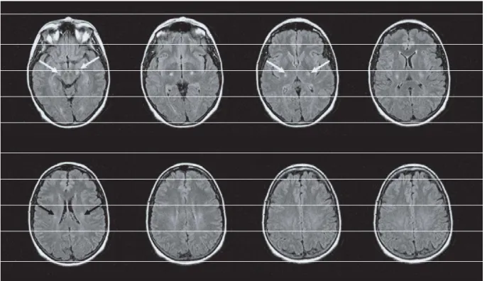 Figure 5-1 : IRM conventionnelle dans la SLA (séquences FLAIR) montre un  hypersignal visible sur le trajet du faisceau corticospinal, depuis les centres 