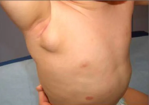 Figure 6: Lymphangiome macrokystique du tronc(13) 