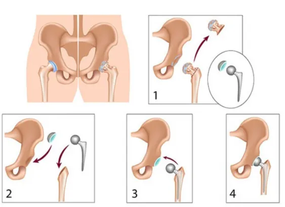 Figure 1.2: Total Hip Replacement Scheme. Source: www.drugwatch.com - hip replacements