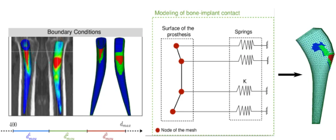 Figure 3.2: Left: Contact zones defined of the prosthesis with a 3D planning. Middle and Right: Bone-implant contact modeling principle.
