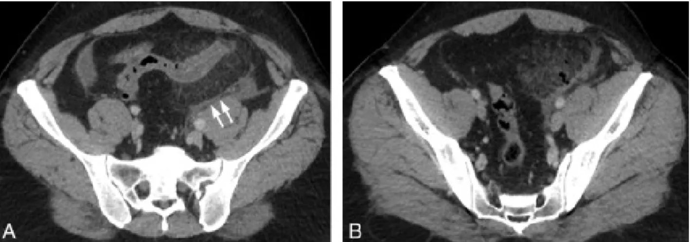 Figure 8 : Images scannographies montrant d’une sigmoïdite infectée. 