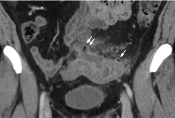 Figure 9 : Sigmoïdite compliquée d’un abcès périsigmoidien 