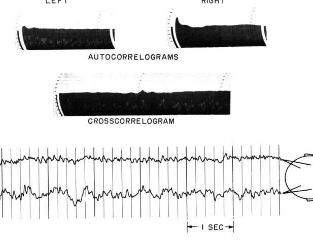 Fig.  XII-6. Autocorrelograms  and  crosscorrelogram  for  the  1-minute  EEG  recording immediately  following  injection  of  75  mg of  sodium  amytal  into  the  right