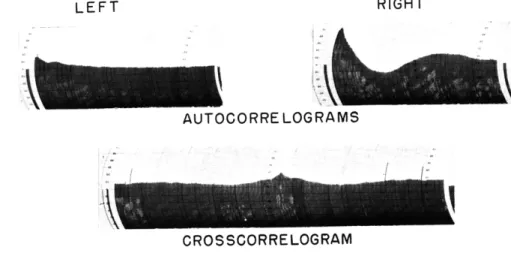 Fig.  XII-7. Autocorrelograms  and  crosscorrelogram  for  the  1-minute  EEG  recording immediately  following  injection  of  200  mg  of  sodium  amytal  into  the  right carotid  artery.