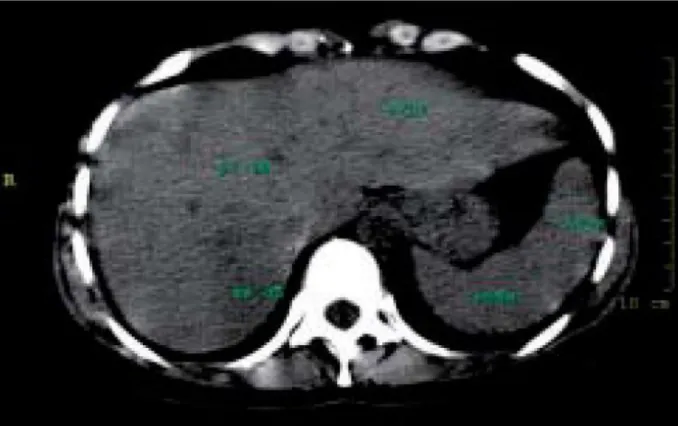 Figure 3 : récidive d'une SHAG : TDM abdominale 3 jours après l'accouchement montrant  une  stéatose hépatique hétérogène prédoominante dans le sepment VII [25] 