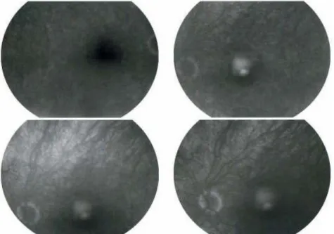 Tableau n°6 : données de l’angiographie chez des patients atteints  d’uvéite toxoplasmique 