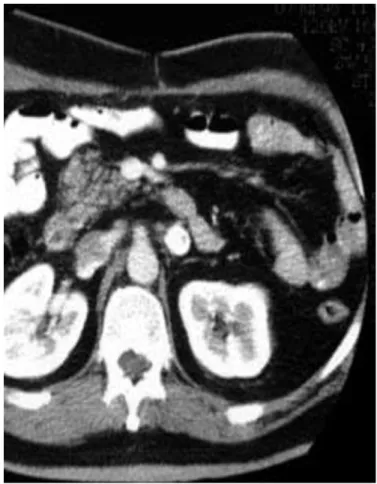 Figure 11 :Coupe axiale avec injection de contraste : Métastase d’un hépatocarcinome. 