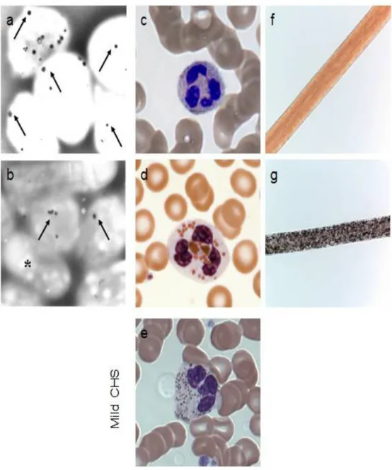 Figure 5:Eléments diagnostiques du SCH[18]. 