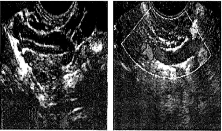Figure 7 : images échographiques des varices para ovariennes. A gauche multiples varices  visibles en transvaginal