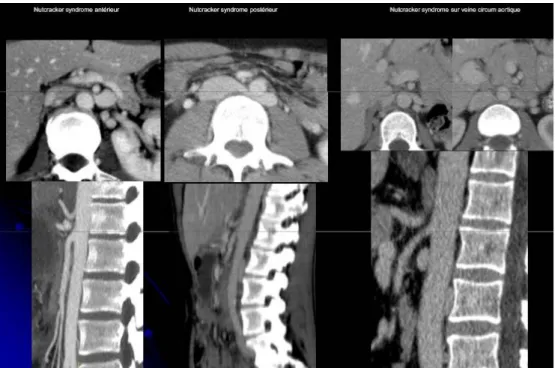 Figure 8  : images scannographique du nutracker syndrome antérieur, postérieure   et de nutcracker syndrome sur veine circum antérieur 