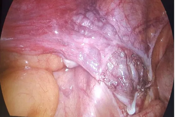 Figure  12  : Aspect turgescent de la muqueuse et dilatation des veines ovariennes 