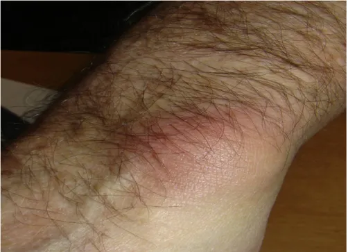 Figure 3: Monoarthrite du poignet gauche [34] 