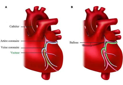 Figure 23 : Techniques de perfusion via les artères ou les veines coronaires, d’après Hajjar et al., 2013 