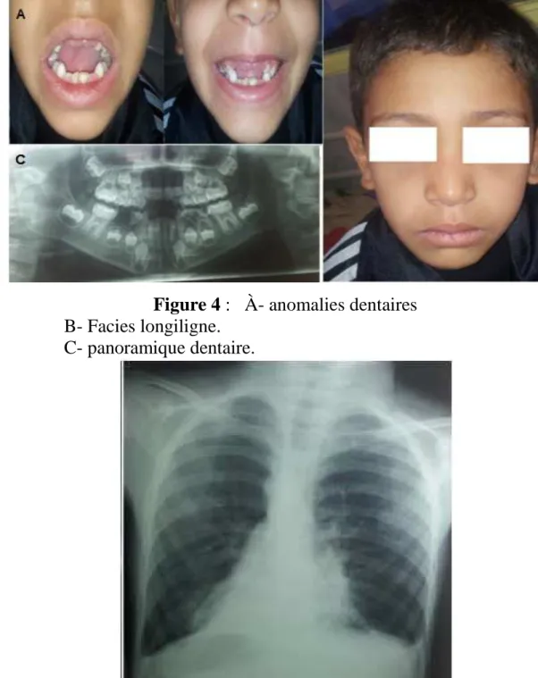 Figure 5 :RX du thorax de face, dextrocardie, bouton aortique à droite. 