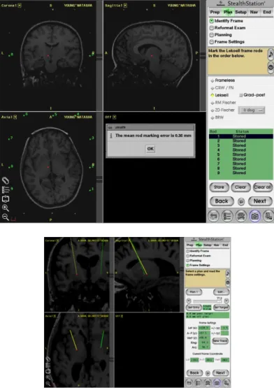 Figure  1.31. Identification des points du cadre, calcul de l’erreur du planning chirurgical (FrameLINK)