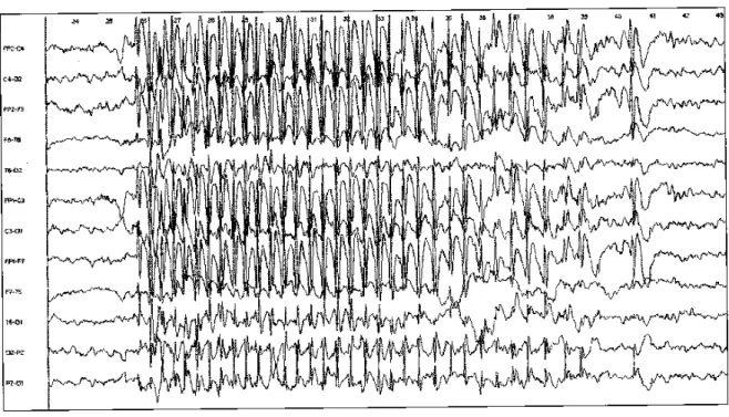 Figure 7 : Enregistrement électro-encéphalographique au  cours du sommeil  montrant des décharges rapides 10Hz, bilatérales et diffuses