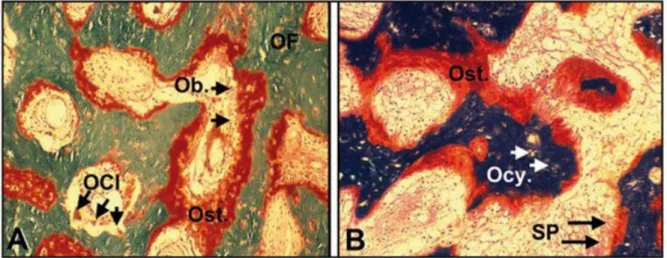 Figure 4: Caractéristiques histologiques des lésions osseuses dans la dysplasie fibreuse  mono-cystique(A) ou polycystique(B)