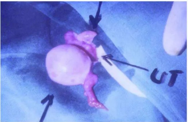 Figure 7: Macrokyste ovarien chez une petite fille porteuse d’un syndrome de McCune- McCune-Albright avec puberté précoce (61)