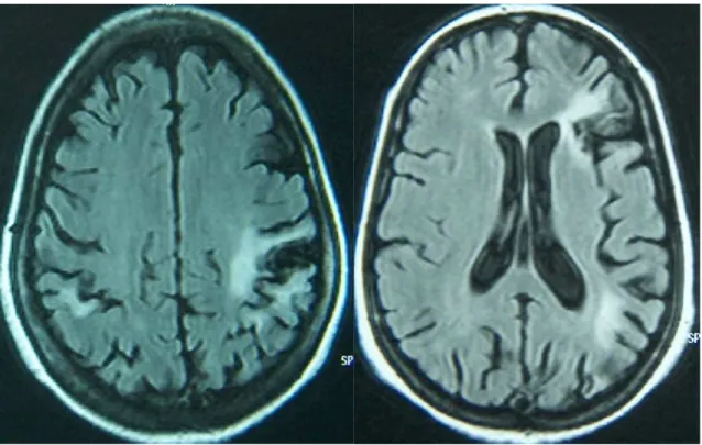 Fig  12,13:  à  gauche :  hyper  signaux  punctiformes  de  la  substance  blanche  sur  IRM  cérébrale  (patiente  N°3)